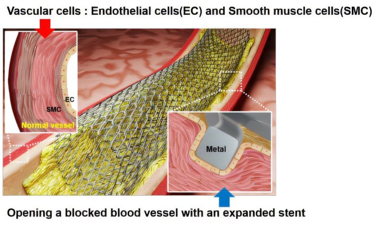 Revolutionizing Stent.jpg