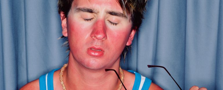 Man With Sunburn Glasses Header.jpg