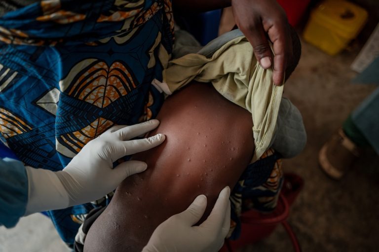 Examination Of Child At Mpox Treatment Centre.tmb 1200v.jpg