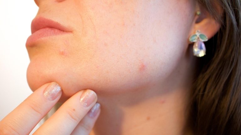 Ayurveda And Homeopathy For Acne 1745997906839 1745997907113.jpg