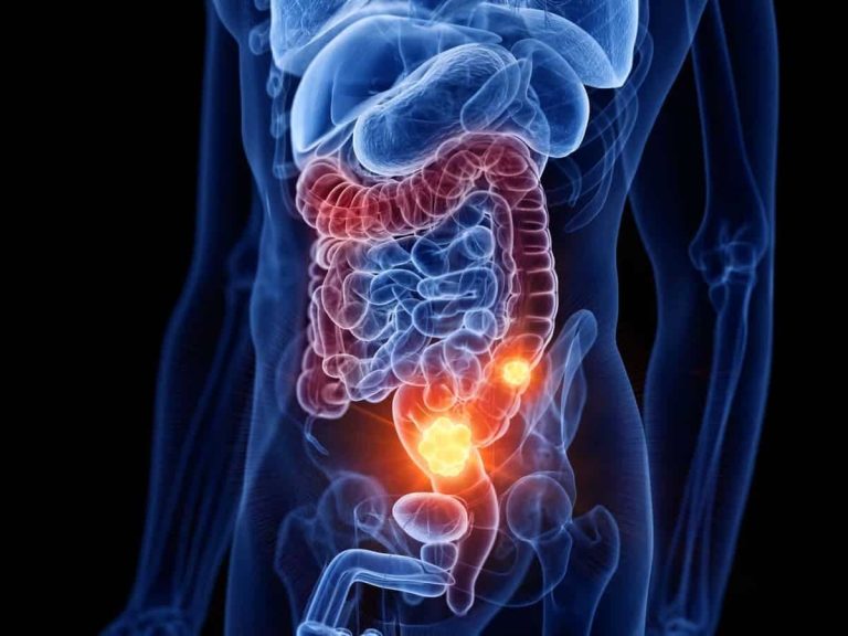 2 Colon Cancer.jpeg
