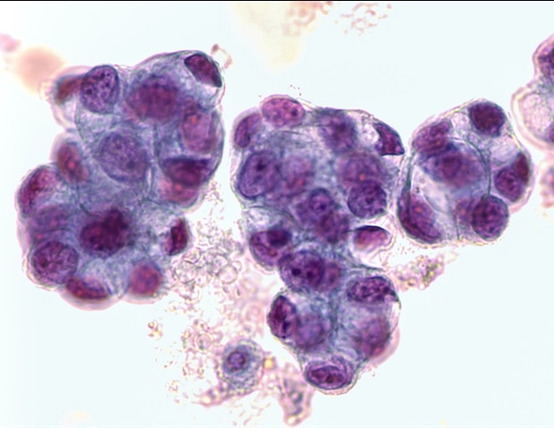 Malignant Fluid Cytology3b Malignant Cells Of Adenocarcinoma May Spread To Fluid David Litman M1.jpeg